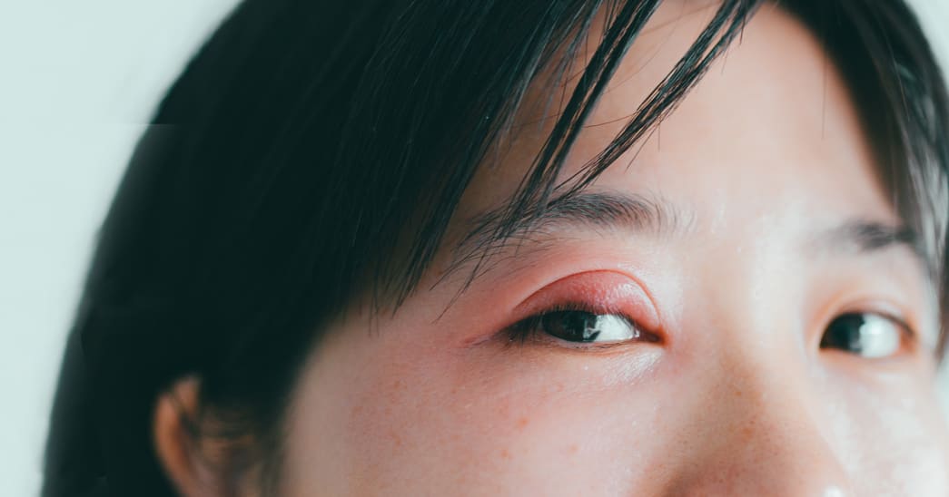 What to Do If You Wear Contacts and Have a Stye | 1-800 Contacts