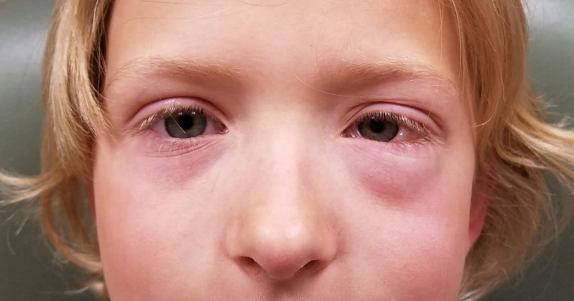 How Do You Get Pink Eye? 1800 Contacts